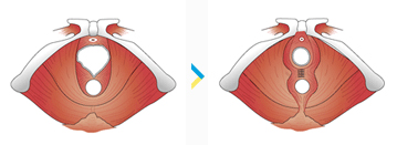 Vaginal-rejuvenation-Tunisia